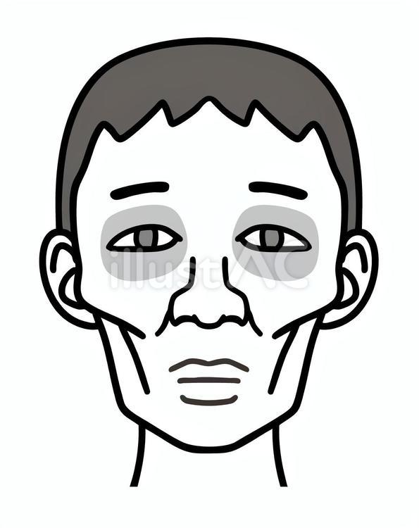 ヒポクラテス顔貌、痩せた男性の顔、白黒 ヒポクラテス顔貌,男性,ヒポクラテスのイラスト素材