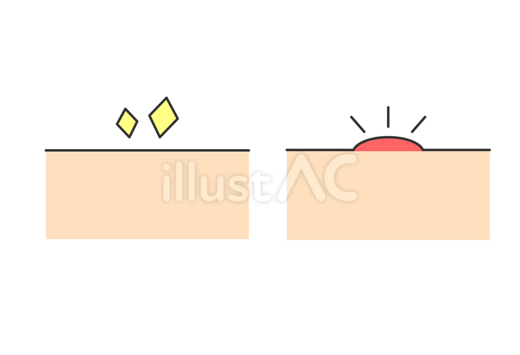 肌の状態比較イラスト（清潔と炎症） 肌,炎症,清潔のイラスト素材