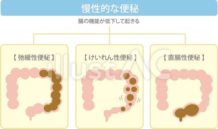 慢性的な便秘_タイプ別 便秘,医療,弛緩性便秘のイラスト素材