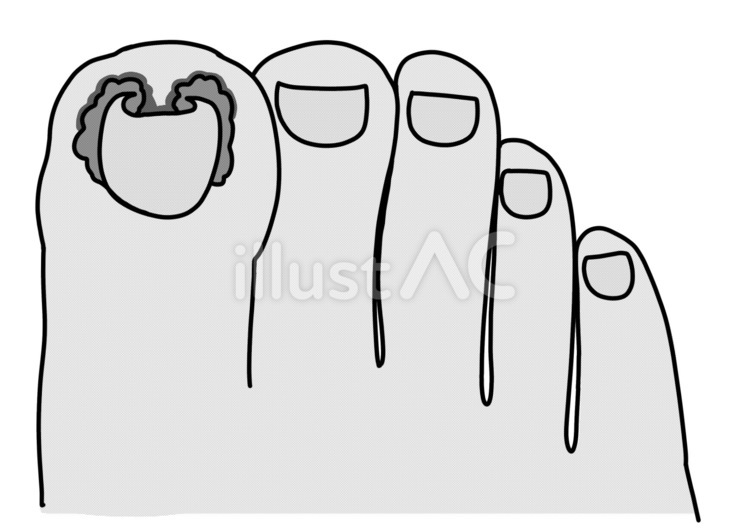 巻き爪による潰瘍と腫脹　上から白黒 巻き爪,潰瘍,腫脹のイラスト素材