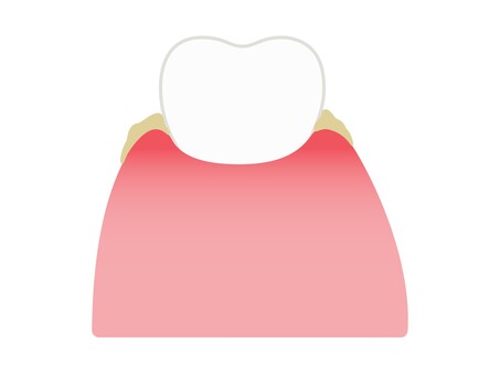 汚れている軽度の歯肉炎の歯（顔なし） 歯周炎,歯,軽度,歯ぐき,腫れ,汚れ,炎症,顔,歯科,説明のイラスト素材