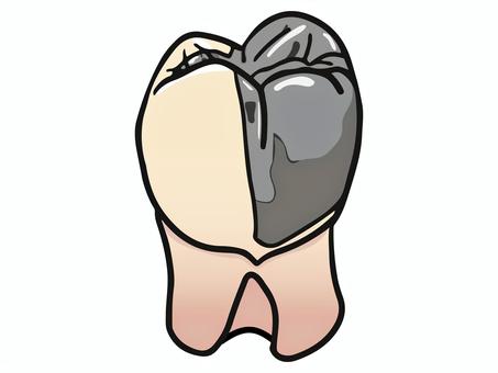 プロキシマルハーフクラウン 歯科,クラウン,補綴,大臼歯,歯科技工,医療,教材用イラスト,vectorのイラスト素材