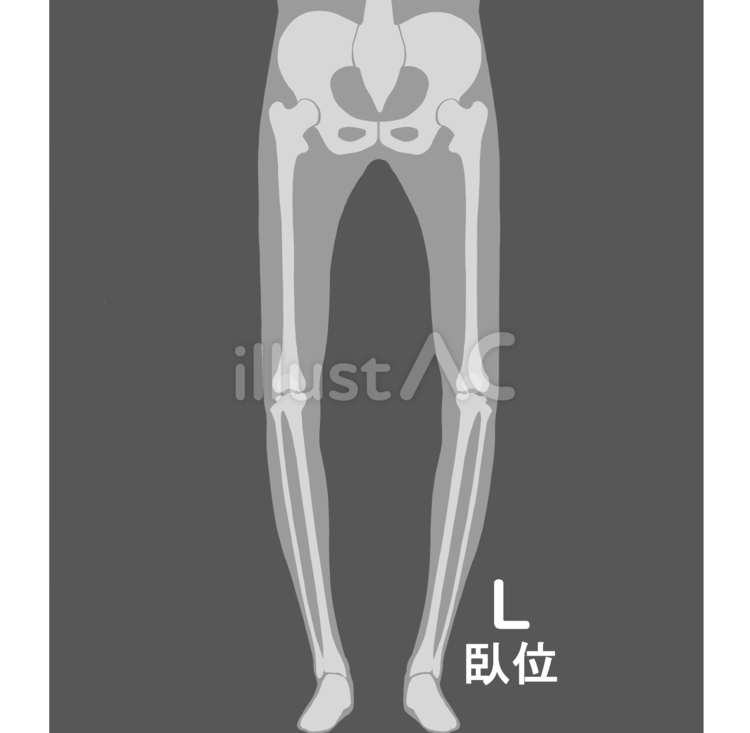 全下肢臥位O脚 医療,レントゲン,撮影のイラスト素材