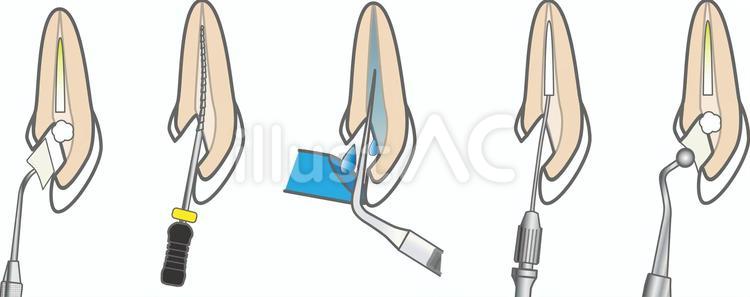根管治療 根管治療,歯科治療,rctのイラスト素材