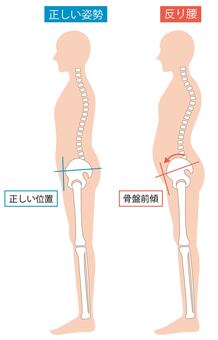 反り腰と正常な姿勢の男性　比べる 反り腰,男性,前傾,骨盤,姿勢,骨格,背骨,人体,比べる,全身のイラスト素材