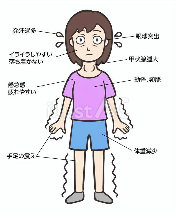 バセドウ病の症状、女性全身、説明あり バセドウ病,甲状腺機能亢進症,眼球突出のイラスト素材