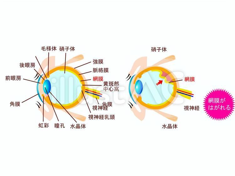 正常な目と緑内障の比較　タイトルなし 緑内障,目,眼のイラスト素材