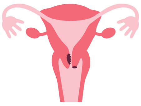 子宮頸がん 子宮頸がん,癌,病気,病巣,子宮,女,卵巣,卵管,膣,卵管采のイラスト素材