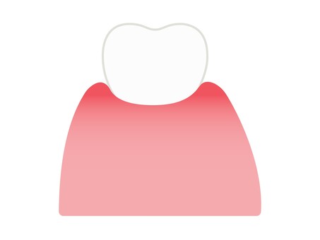 軽度の歯肉炎の歯　 歯周炎,歯,軽度,歯ぐき,腫れ,炎症,顔,歯科,説明,歯周病のイラスト素材