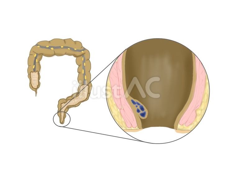 痔 大腸,肛門括約筋,排便のイラスト素材
