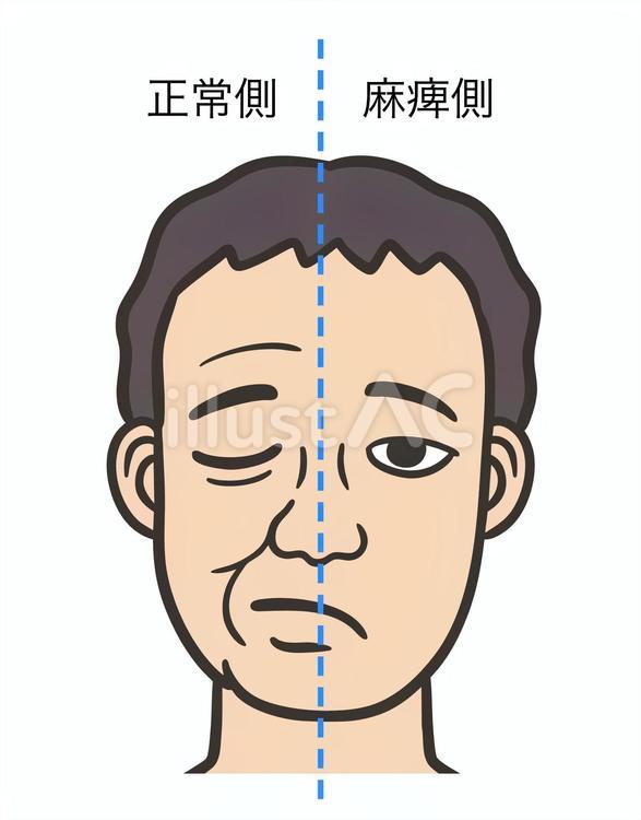 正常側と麻痺側、男性の顔2 顔面神経麻痺,ベル麻痺,ベル現象のイラスト素材