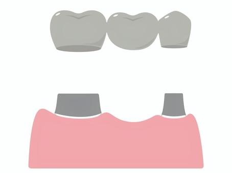 歯科　差し歯（ブリッジ）の説明イラスト ブリッジ,差し歯,冠,被せ物,歯,金属,単体,メタル,奥歯,臼歯のイラスト素材