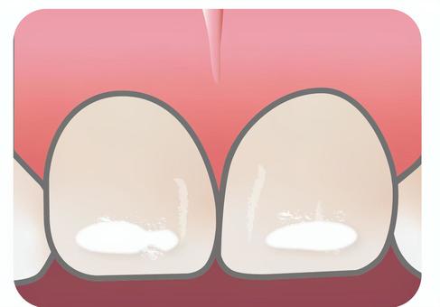 ホワイトスポット２ 歯,前歯,ホワイトスポット,白濁,むし歯,歯科,中切歯のイラスト素材