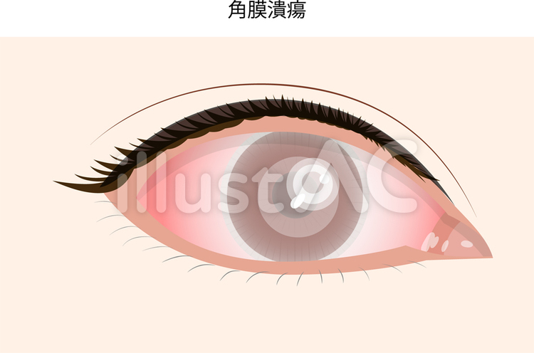 目の病気 眼の病気,病気,眼のイラスト素材