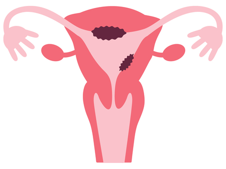 子宮体がん 子宮体がん,癌,病気,病巣,子宮,女,卵巣,卵管,膣,卵管采のイラスト素材