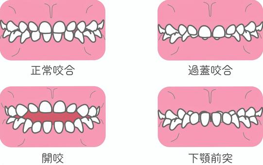 乳歯列セット 歯科,矯正,かみ合わせ,乳歯列,正常咬合,過蓋咬合,開咬,下顎前突,子どものイラスト素材