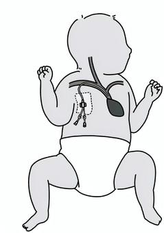 乳児に中心静脈カテーテル 白黒 乳児に中心静脈カテーテル 白黒 乳児,小児科,中心静脈,カテーテル,血管,白黒のイラスト素材