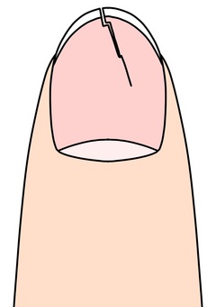 縦にひび割れた爪　カラー ひび割れ,爪,トラブル,縦,カラーのイラスト素材