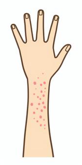 Illustration, eczema, grumbling, skin, 