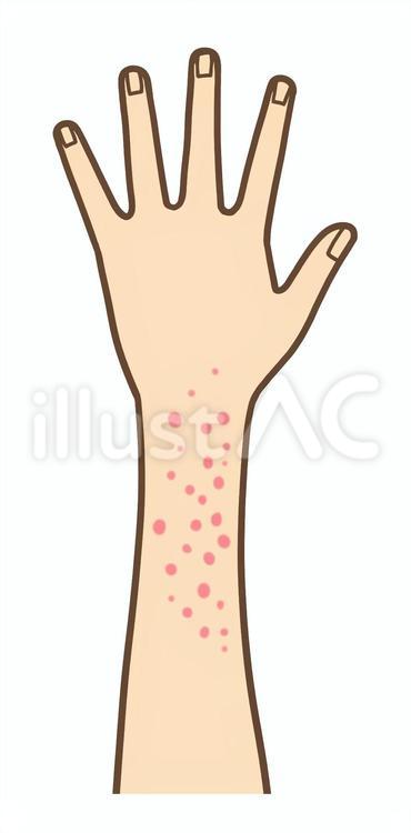 赤い湿疹が出た腕 湿疹,ぶつぶつ,皮膚のイラスト素材