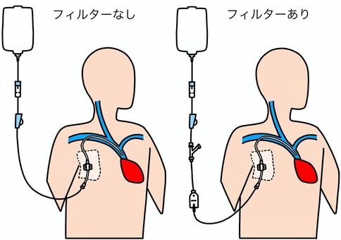 中心静脈カテーテルフィルター有無 カラー 中心静脈カテーテルフィルター有無 カラー 中心静脈,カテーテル,フィルター,血管,カラーのイラスト素材