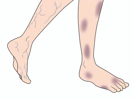 足の不調 足,血管,あざ,不調,静脈のイラスト素材