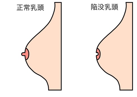 正常と陥没乳頭比較 カラー 正常と陥没乳頭比較 カラー 正常,乳頭,陥没,比較,カラーのイラスト素材