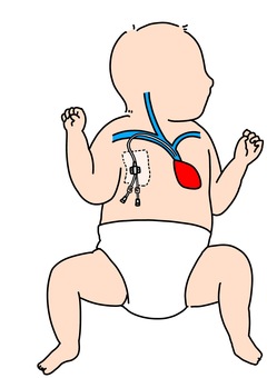 乳児に中心静脈カテーテル カラー 乳児に中心静脈カテーテル カラー 乳児,小児科,血管,中心静脈,カテーテル,カラーのイラスト素材