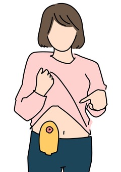Illustration, stomie, fem, ostomate, 