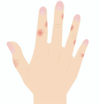 赤切れ あかぎれ,ひび,手,乾燥,指,傷,皮膚,痛み,手荒れ,湿疹のイラスト素材
