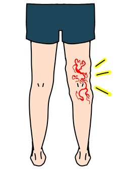 膝裏の静脈瘤　 膝,裏,足,静脈瘤,血管のイラスト素材
