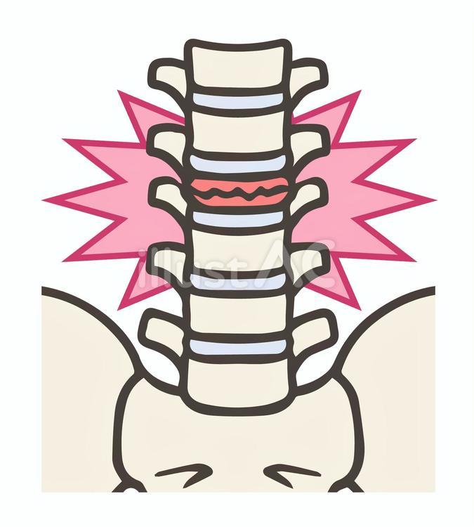 椎体圧迫骨折、エフェクトあり 圧迫骨折,椎体,腰椎のイラスト素材