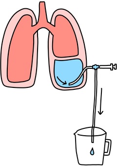 Illustration, pleuropuncture, treatment, syringe, 