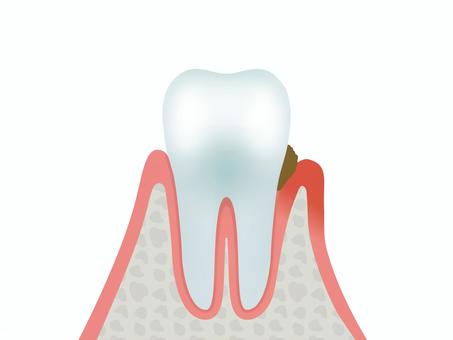 Illustration, periodontal disease, real, alveolar bone, 