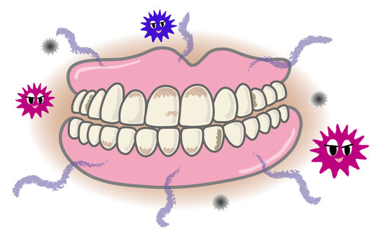汚くなった入れ歯 入れ歯,汚れ,汚い,不潔,ヤニ,歯石,歯垢,口臭,ばい菌,菌のイラスト素材