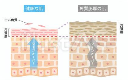 角質肥厚 健康な肌 断面図