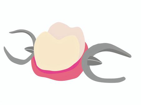 上の歯の部分入れ歯のイラスト 歯科,歯医者,義歯,部分入れ歯,一本義歯,パーシャルデンチャー,部分義歯,上顎,キャストクラスプ,クラスプのイラスト素材