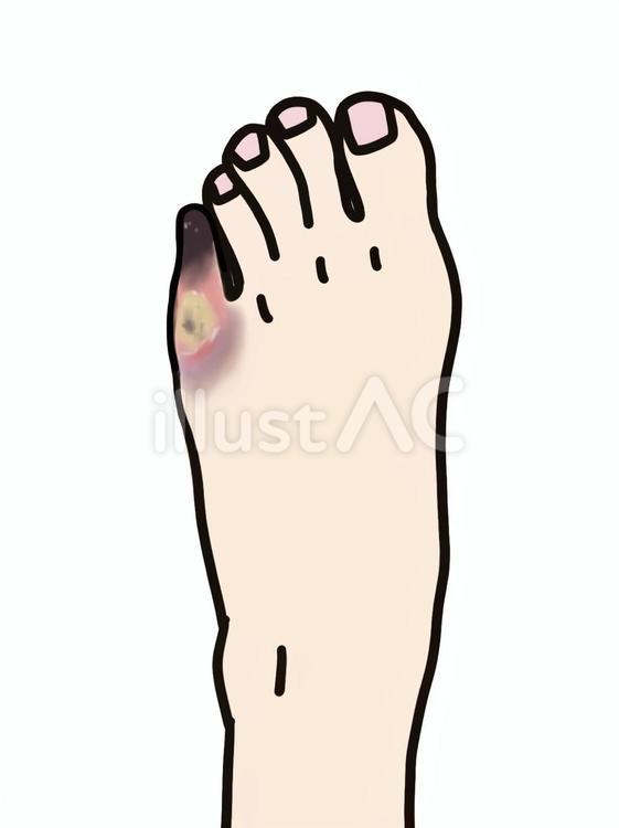 足の潰瘍と壊疽 壊死,足,壊疽のイラスト素材
