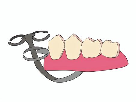 上の歯の部分入れ歯のイラスト（主線あり） 歯科,義歯,部分入れ歯,上顎,医療,クラスプ,歯科技工,人工歯,教材用イラスト,vectorのイラスト素材