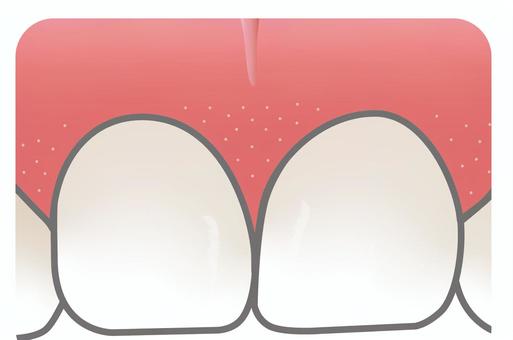 スティップリング 歯,歯ぐき,スティップリング,前歯,歯間乳頭,健康のイラスト素材