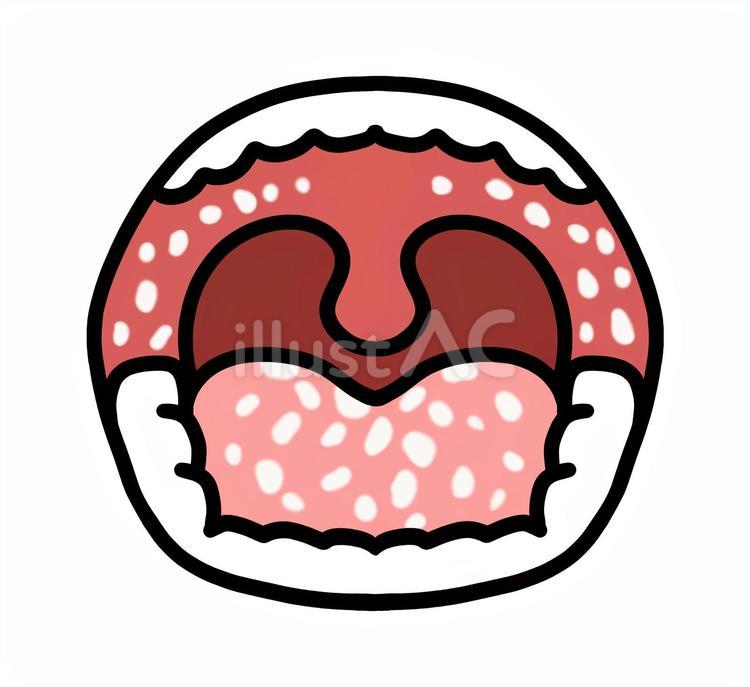 症状が出ている口腔内1 口腔,カンジダ症,カンジダのイラスト素材