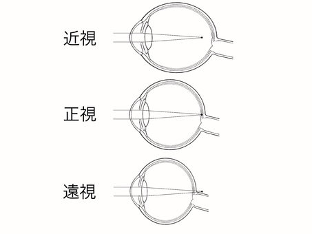 Position of focus for myopia, emmetropia, and hyperopia, JPG and PNG Position of focus for myopia, emmetropia, and hyperopia, myopia, face, hyperopia, JPG and PNG