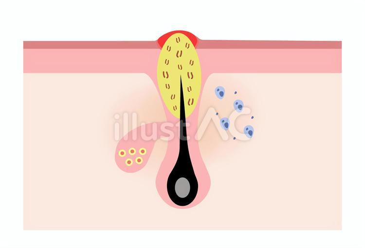膿を持った黄色ニキビ（炎症性ニキビ） 皮膚,毛穴,毛根のイラスト素材