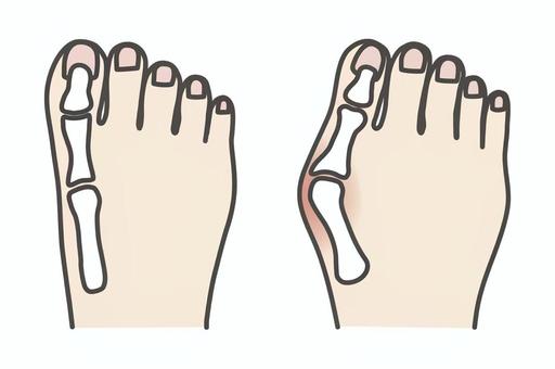 Illustration, hallux valgus, leg, transformation, 