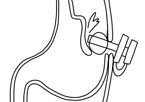 腹腔内誤挿入になった胃瘻　線画