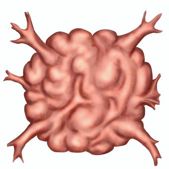 Illustration, tumor, heart, meat, 