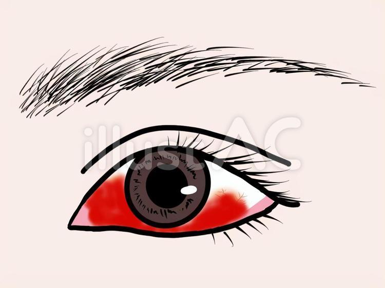 結膜下出血　充血　眼球　 結膜下出血,目,病気のイラスト素材