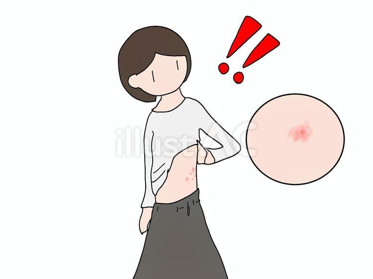 帯状疱疹？皮膚の赤い発疹に気付く 帯状疱疹,発疹,皮膚のイラスト素材