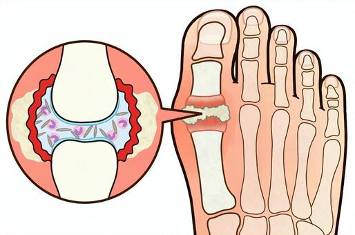 痛風の関節の状態（内側・詳細） 痛風,痛風結節,尿酸結節,尿酸結晶,発作,図解,構造,尿酸,尿酸値,生活習慣病のイラスト素材