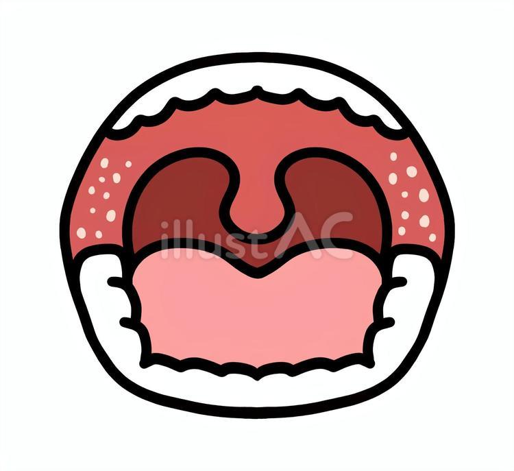 症状が出ている口腔内2 麻疹,はしか,コプリック斑のイラスト素材